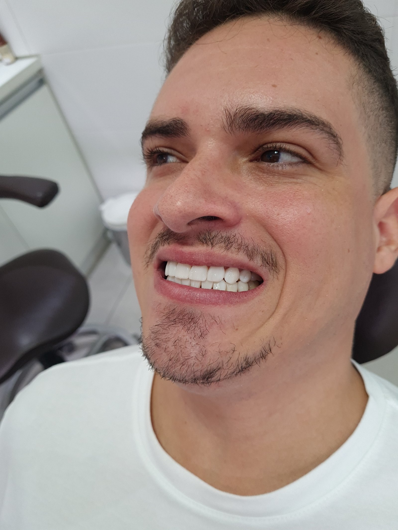 Depois do tratamento - Lentes de contato dental