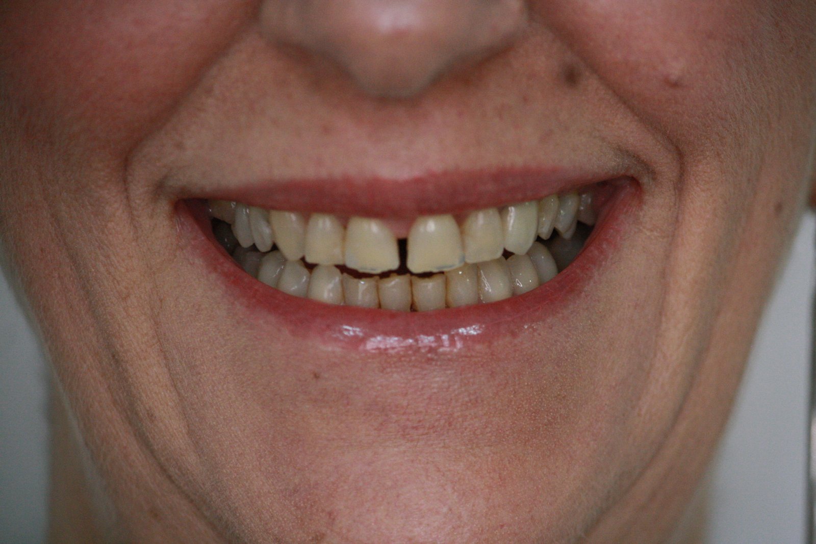 Antes do tratamento - Lentes de contato dental