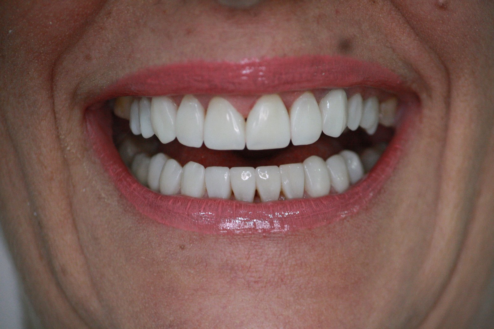 Depois do tratamento - Lentes de contato dental